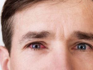 Leia mais sobre o artigo Conjuntivite: como prevenir.