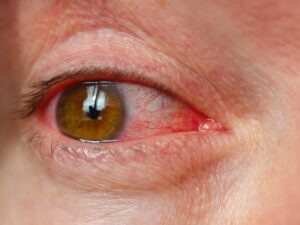 Leia mais sobre o artigo Pomadas de trançar/modelar cabelos e problemas nos olhos