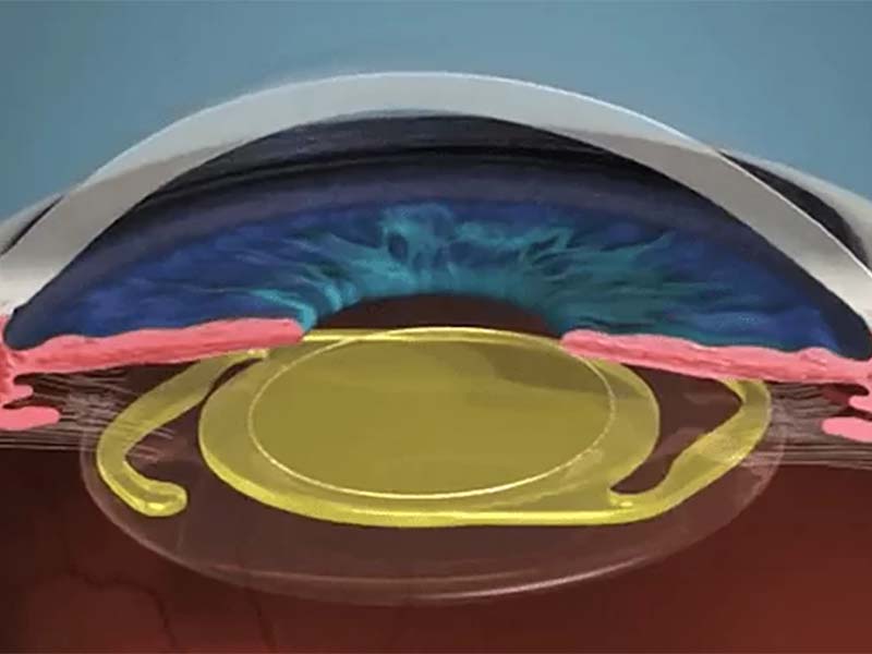 Você está visualizando atualmente Lentes Intraoculares Premium: Uma Visão Clara sobre a Tecnologia Ocular Avançada