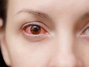 Leia mais sobre o artigo Conjuntivite no verão: cuidados essenciais para proteger os olhos